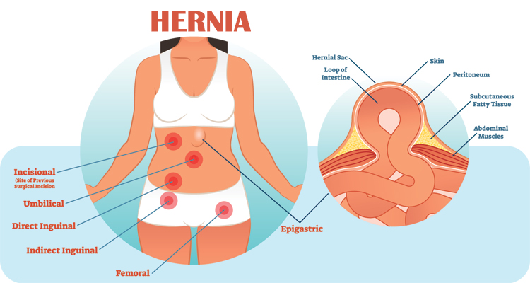 Basic Information About Hernia